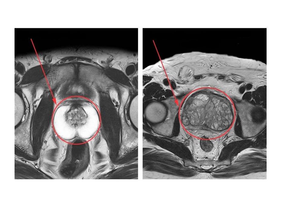 Vergleich einer gesunden (links) und einer entzündeten (rechts) Prostata auf MRT-Bildern